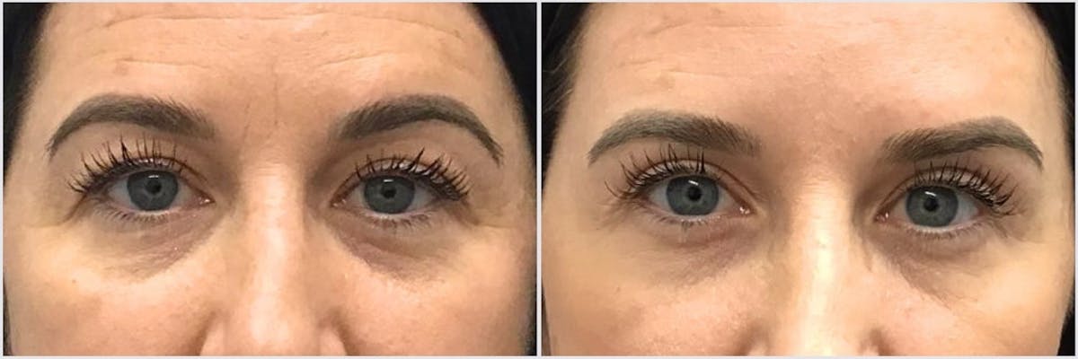 Upper Blepharoplasty Before & After Gallery - Patient 191913 - Image 1