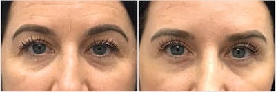 Upper Blepharoplasty Before & After Gallery - Patient 191913 - Image 1