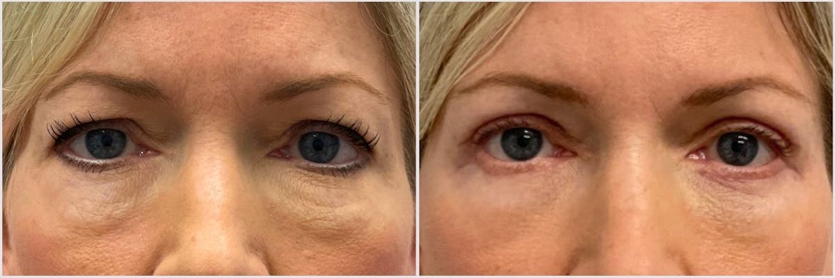 Upper & Lower Blepharoplasty Before & After Gallery - Patient 118533 - Image 1