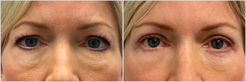 TCA Peel Before & After Gallery - Patient 149330 - Image 1