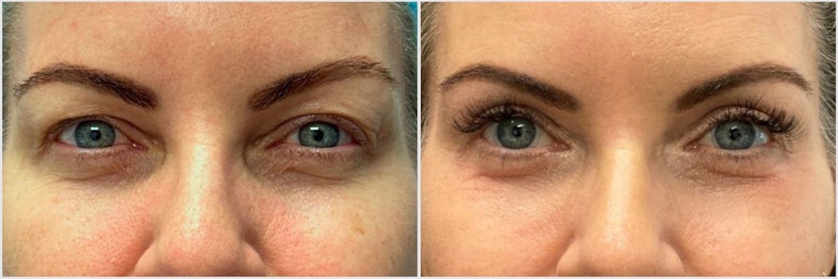 Upper Blepharoplasty Before & After Gallery - Patient 148232 - Image 1