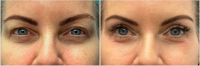 Upper Blepharoplasty Before & After Gallery - Patient 148232 - Image 1