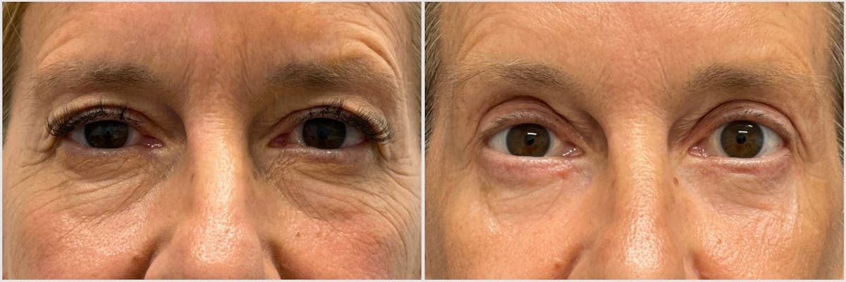 Upper & Lower Blepharoplasty Before & After Gallery - Patient 208431 - Image 1