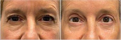Upper & Lower Blepharoplasty Before & After Gallery - Patient 208431 - Image 1