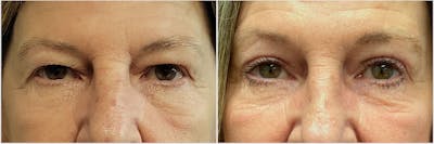 Upper Blepharoplasty Before & After Gallery - Patient 279957 - Image 1
