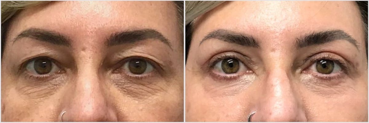 Upper & Lower Blepharoplasty Before & After Gallery - Patient 655059 - Image 1