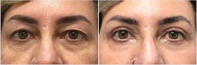 Upper & Lower Blepharoplasty Before & After Gallery - Patient 655059 - Image 1