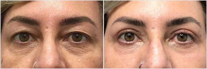 Laser Resurfacing Before & After Gallery - Patient 206425 - Image 1