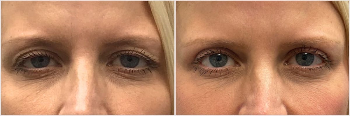 Upper Blepharoplasty Before & After Gallery - Patient 213032 - Image 1