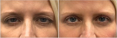 Upper Blepharoplasty Before & After Gallery - Patient 213032 - Image 1
