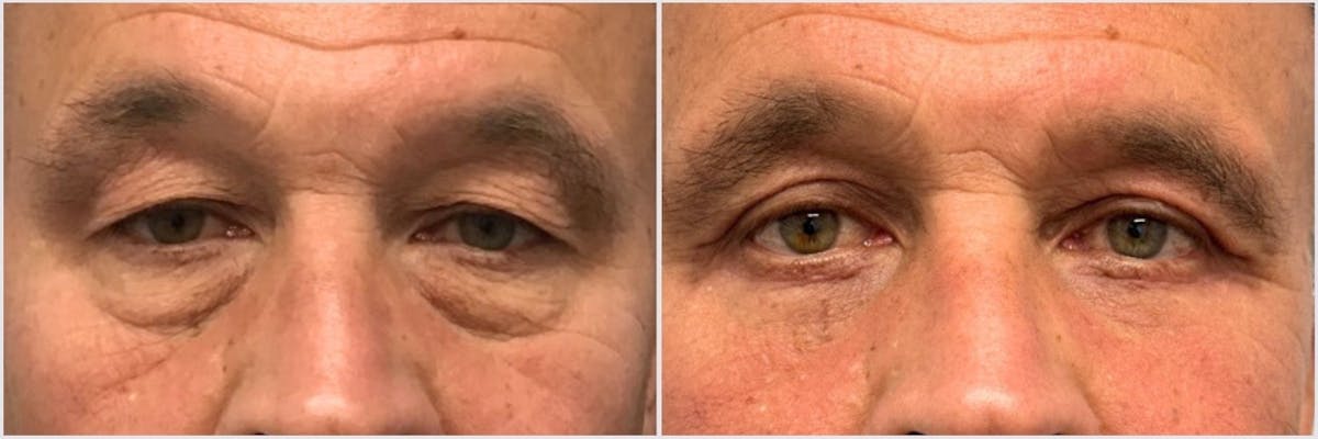 Upper & Lower Blepharoplasty Before & After Gallery - Patient 778498 - Image 1