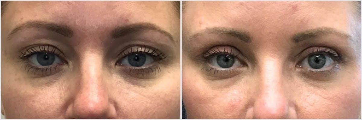 Upper Blepharoplasty Before & After Gallery - Patient 304898 - Image 1