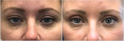 Upper Blepharoplasty Before & After Gallery - Patient 304898 - Image 1