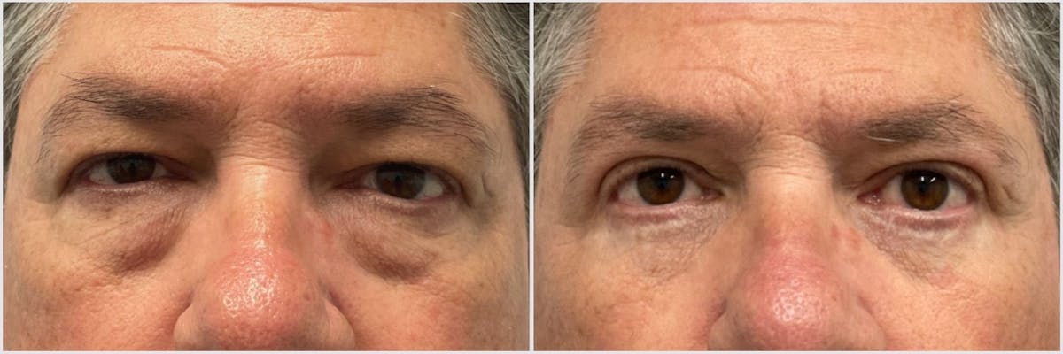 Upper & Lower Blepharoplasty Before & After Gallery - Patient 801973 - Image 1