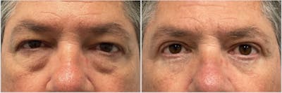 Upper & Lower Blepharoplasty Before & After Gallery - Patient 801973 - Image 1
