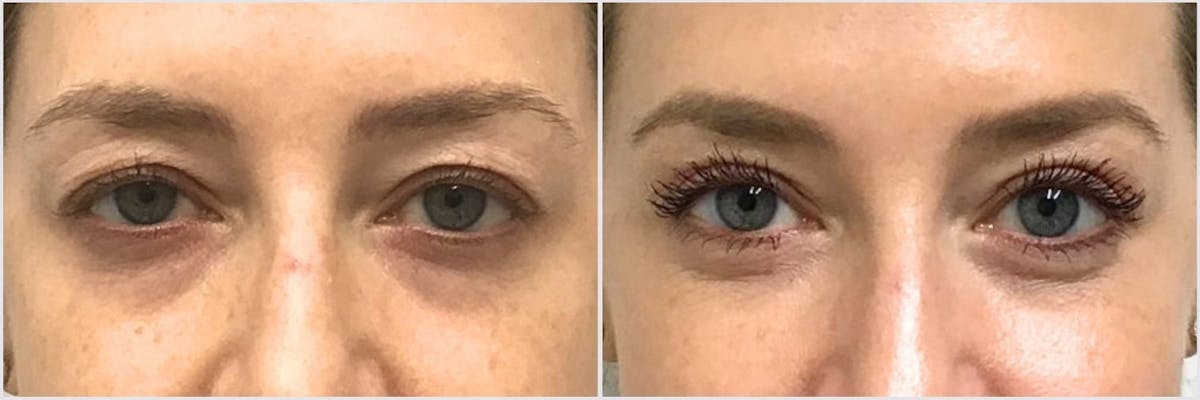 Upper Blepharoplasty Before & After Gallery - Patient 320844 - Image 1