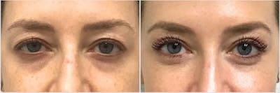 Upper Blepharoplasty Before & After Gallery - Patient 320844 - Image 1