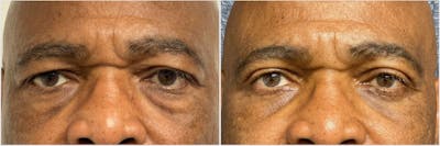 Upper & Lower Blepharoplasty Before & After Gallery - Patient 433273 - Image 1