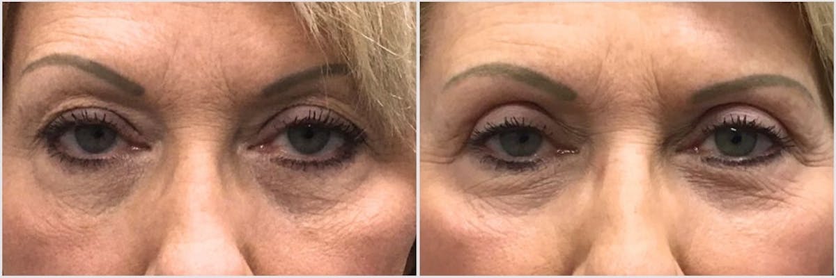 Upper Blepharoplasty Before & After Gallery - Patient 227844 - Image 1