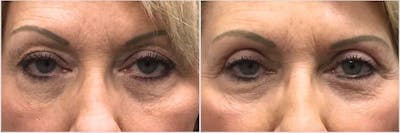 Upper Blepharoplasty Before & After Gallery - Patient 227844 - Image 1