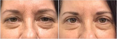 Upper Blepharoplasty Before & After Gallery - Patient 237904 - Image 1