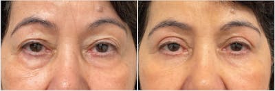 Upper & Lower Blepharoplasty Before & After Gallery - Patient 610608 - Image 1