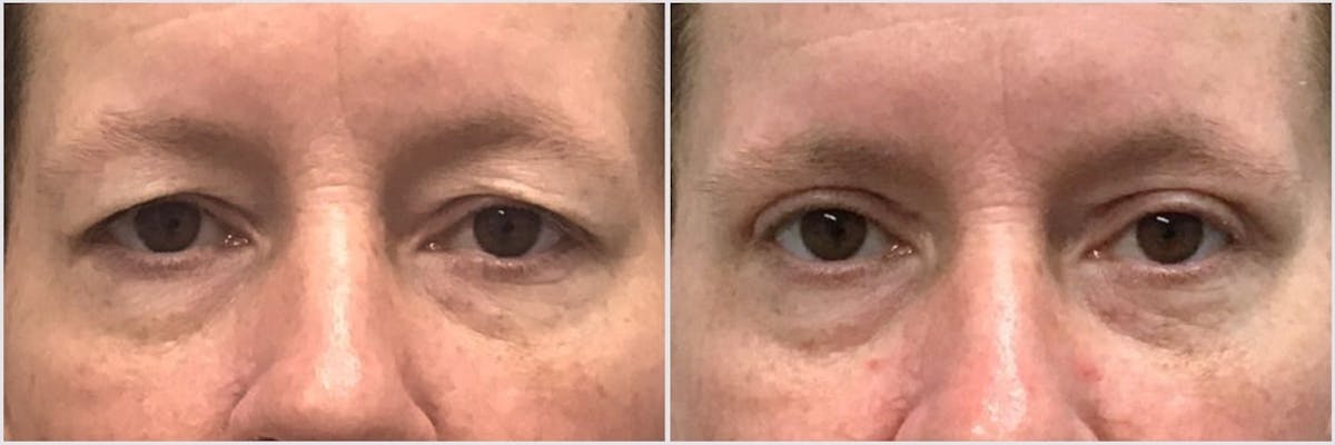 Upper Blepharoplasty Before & After Gallery - Patient 106199 - Image 1