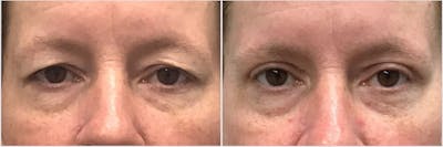 Upper Blepharoplasty Before & After Gallery - Patient 106199 - Image 1