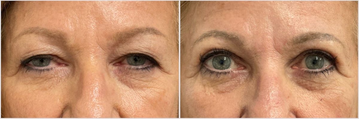 Upper Blepharoplasty Before & After Gallery - Patient 427834 - Image 1
