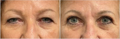 Upper Blepharoplasty Before & After Gallery - Patient 427834 - Image 1