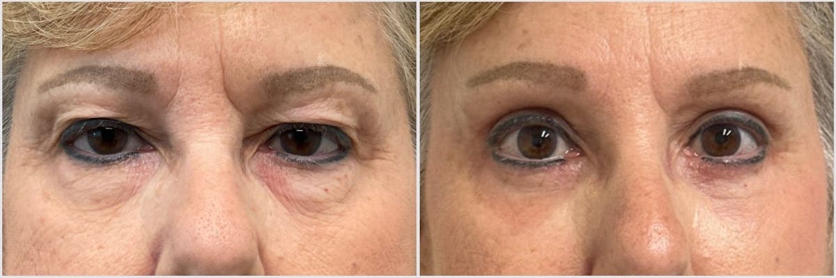 Brow Lift Before & After Gallery - Patient 840817 - Image 1