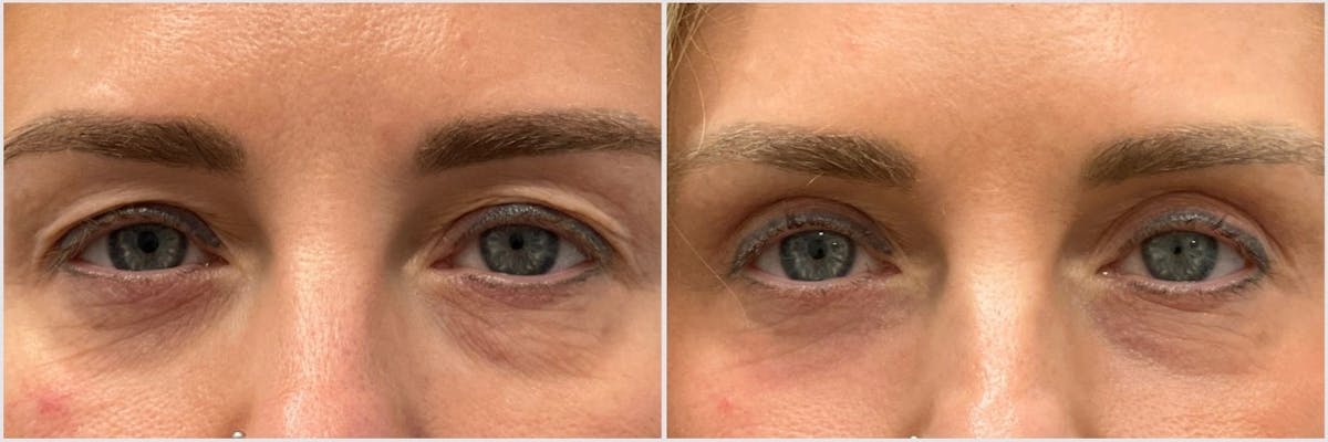 Upper Blepharoplasty Before & After Gallery - Patient 292609 - Image 1