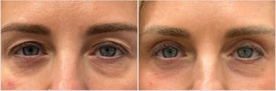 Upper Blepharoplasty Before & After Gallery - Patient 292609 - Image 1