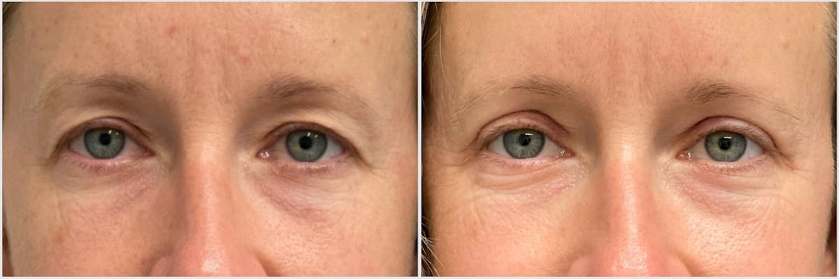 Upper Blepharoplasty Before & After Gallery - Patient 143798 - Image 1