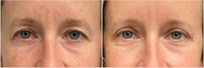 Upper Blepharoplasty Before & After Gallery - Patient 143798 - Image 1