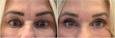 Upper Blepharoplasty Before & After Gallery - Patient 597887 - Image 1