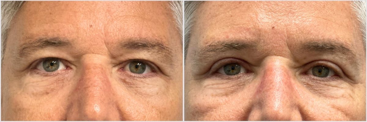 Upper Blepharoplasty Before & After Gallery - Patient 148434 - Image 1