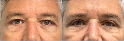 Upper Blepharoplasty Before & After Gallery - Patient 148434 - Image 1