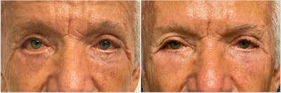 Revision Surgery Before & After Gallery - Patient 428263 - Image 1