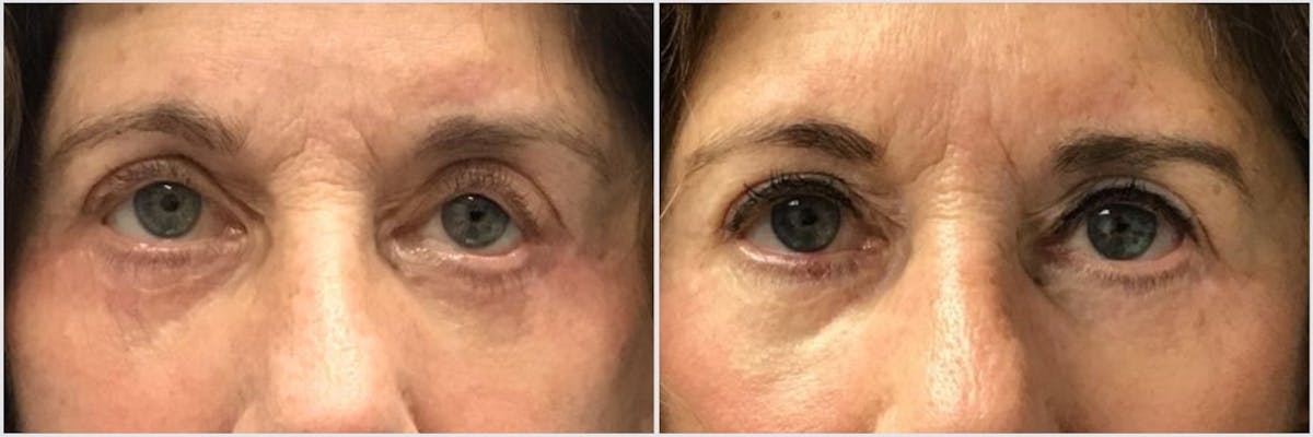 Revision Surgery Before & After Gallery - Patient 353679 - Image 1