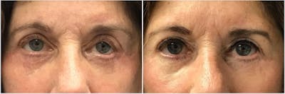 Revision Surgery Before & After Gallery - Patient 353679 - Image 1