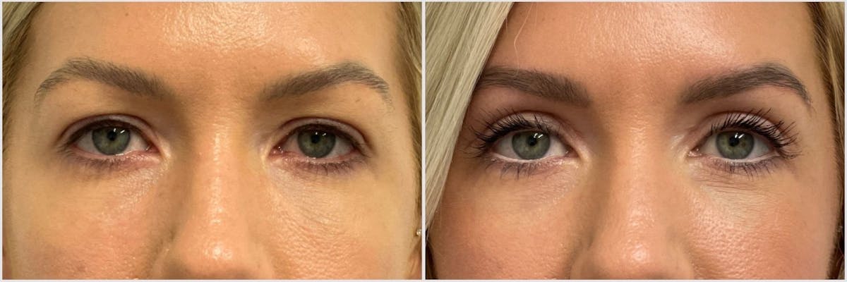 Upper Blepharoplasty Before & After Gallery - Patient 382296 - Image 1