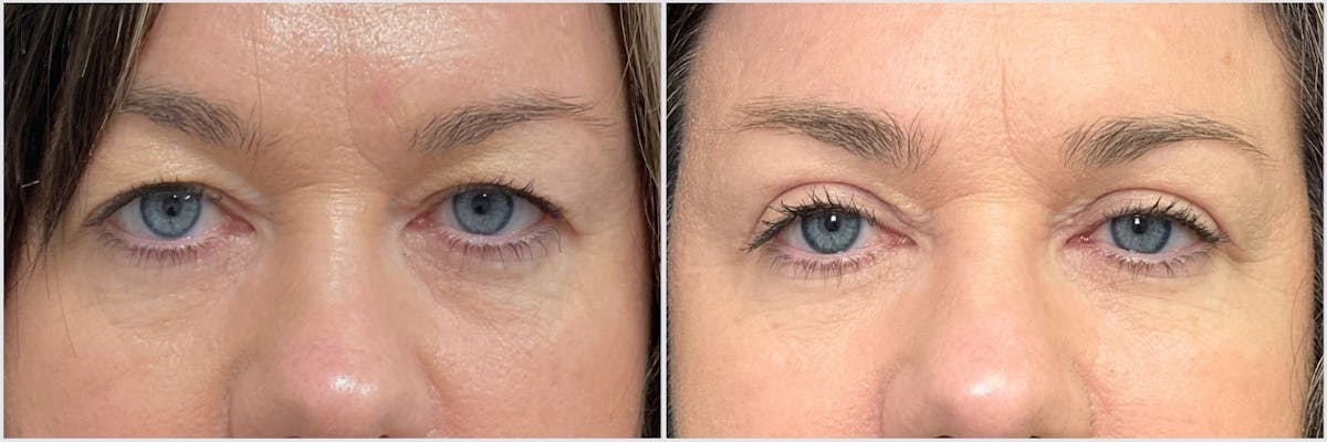 Upper Blepharoplasty Before & After Gallery - Patient 781189 - Image 1
