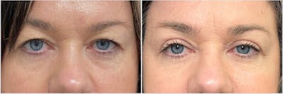 Upper Blepharoplasty Before & After Gallery - Patient 781189 - Image 1