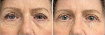 Upper & Lower Blepharoplasty Before & After Gallery - Patient 165110 - Image 1