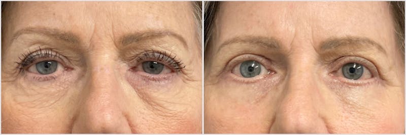 TCA Peel Before & After Gallery - Patient 244166 - Image 1