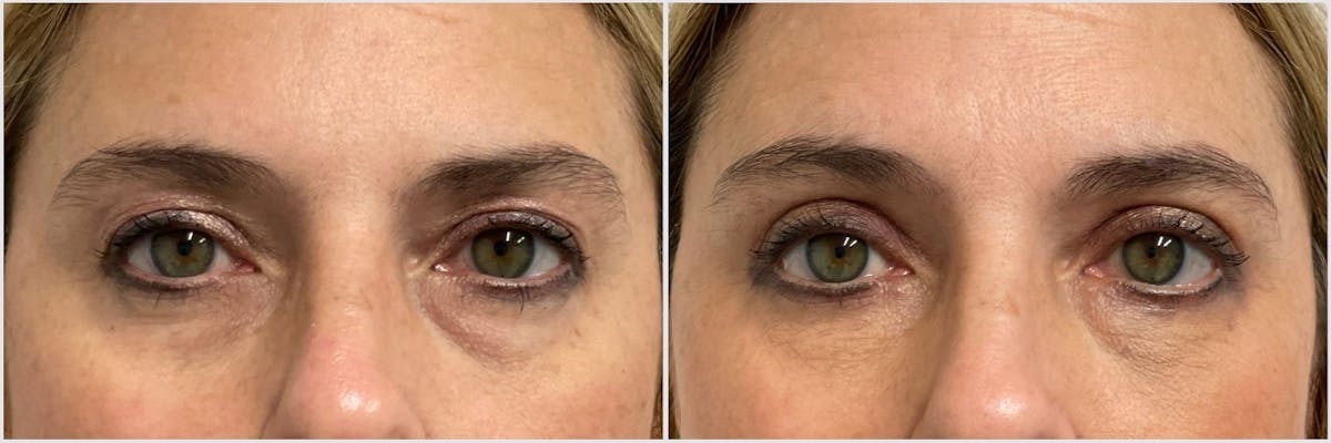 Upper & Lower Blepharoplasty Before & After Gallery - Patient 189350 - Image 1