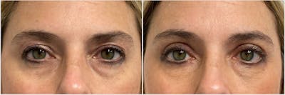 Upper & Lower Blepharoplasty Before & After Gallery - Patient 189350 - Image 1