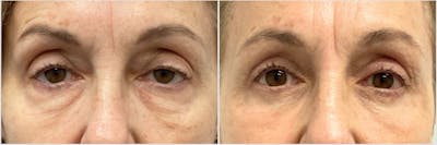 Upper & Lower Blepharoplasty Before & After Gallery - Patient 404245 - Image 1