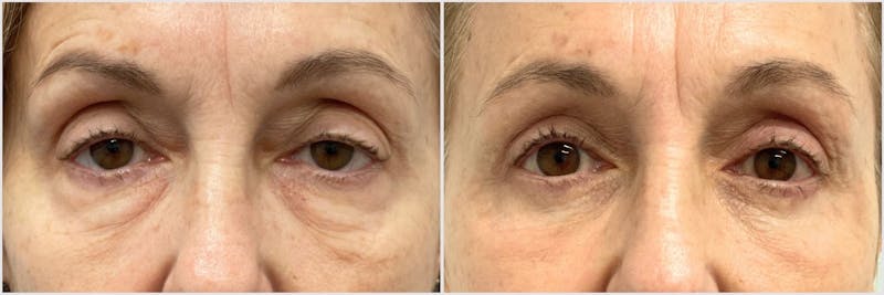 TCA Peel Before & After Gallery - Patient 619443 - Image 1